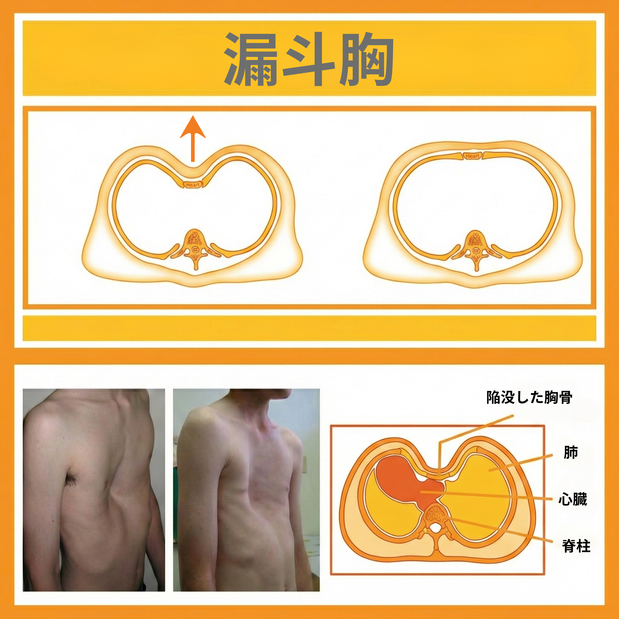 漏斗胸のためのバキュームベル | ScolioLife®